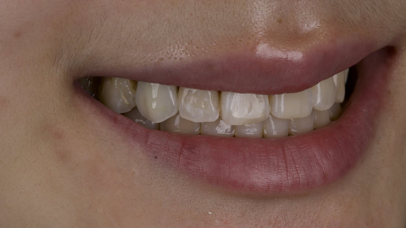 A crown matched to the surrounding teeth, on a patient of the practice