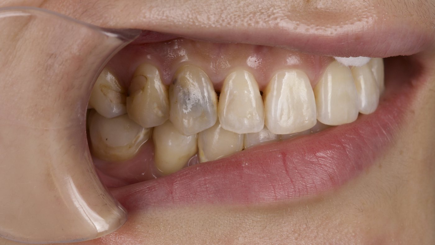 Before: a discolored front tooth