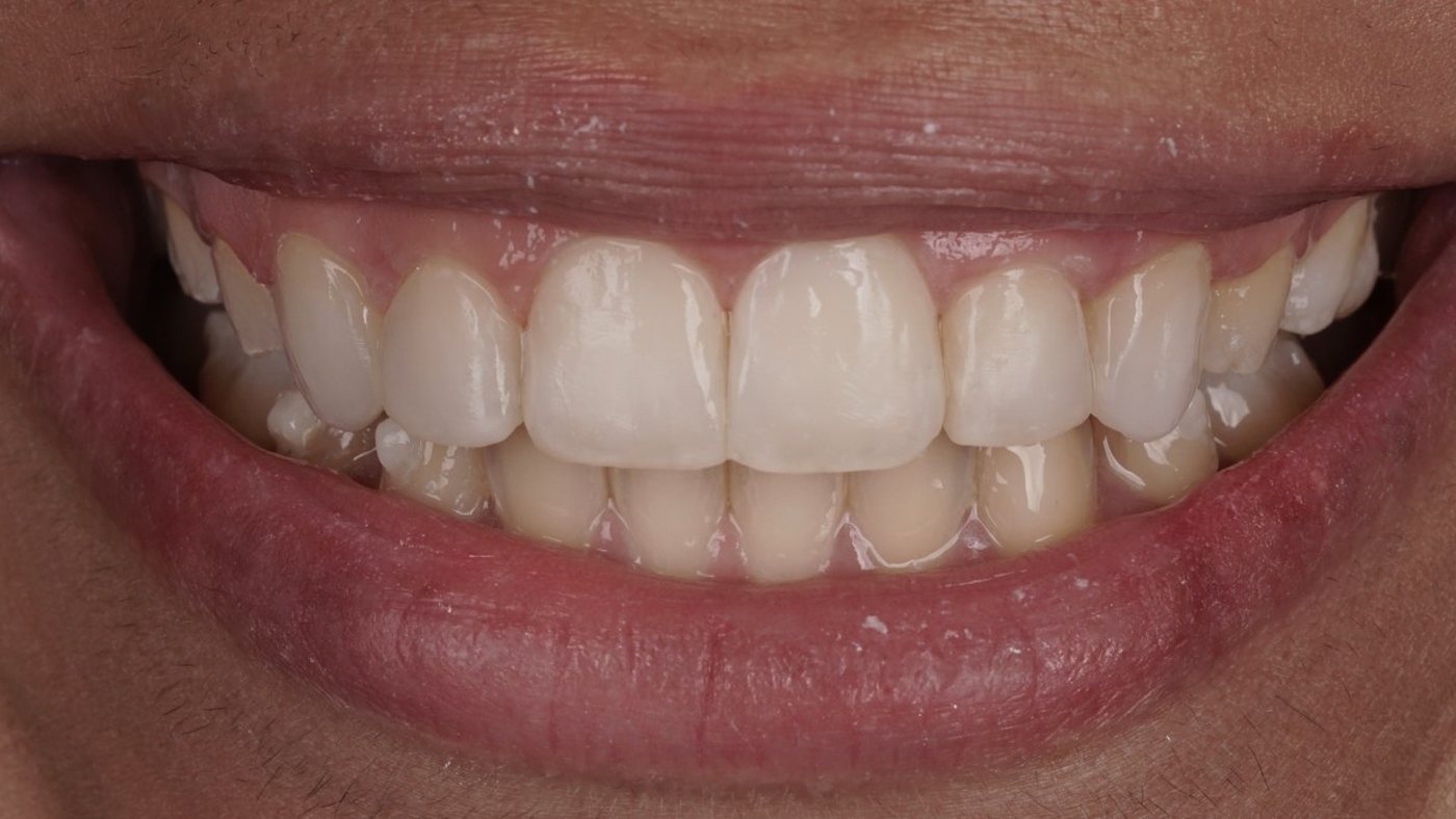 After: chairside resin veneers across the upper arch