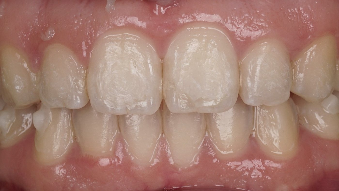 Before: uneven, worn upper front teeth