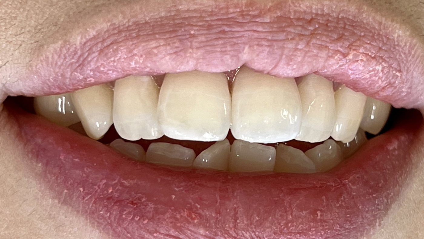 After: A chipped front tooth before and after chairside restoration