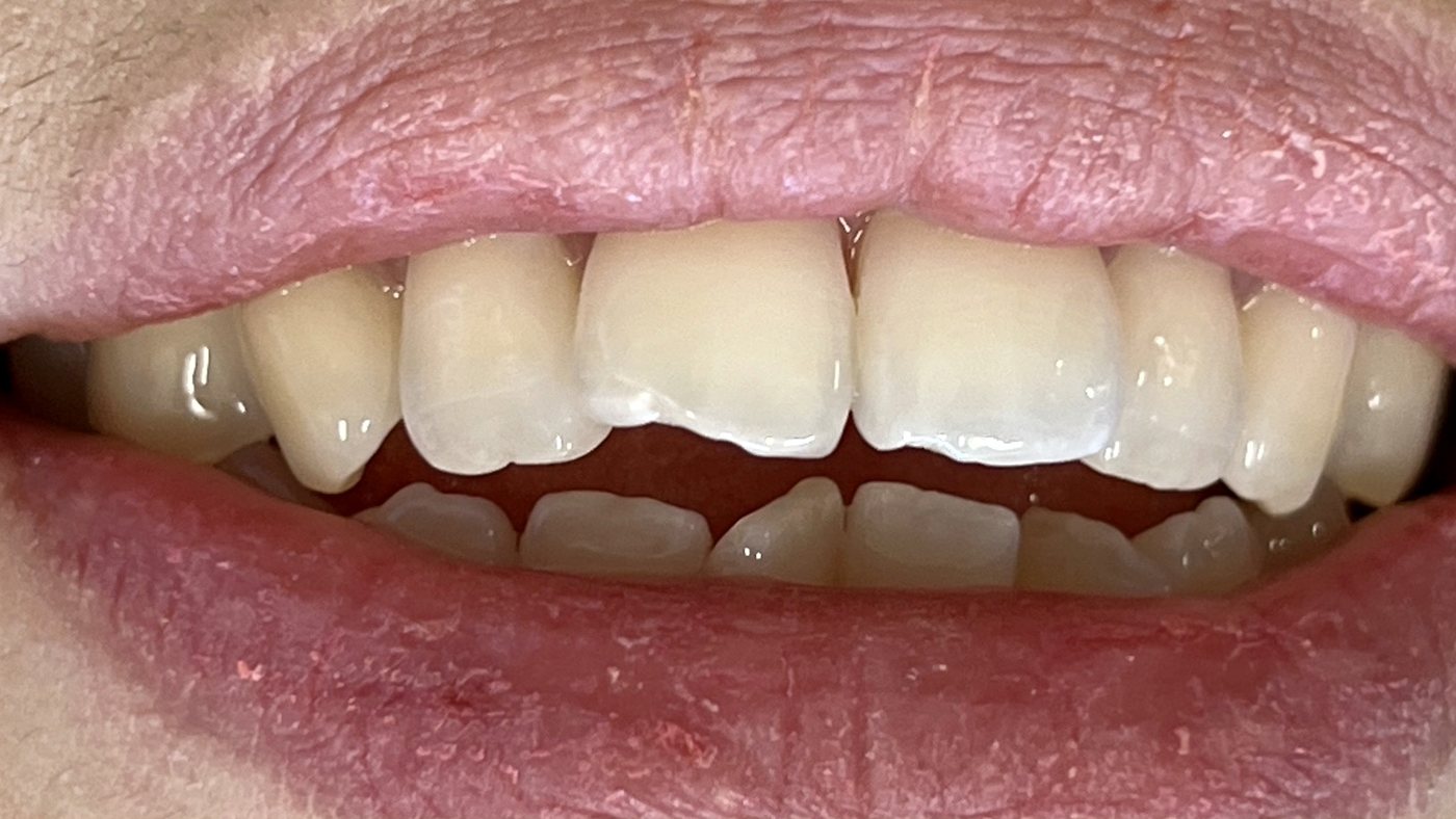 Before: A chipped front tooth before and after chairside restoration
