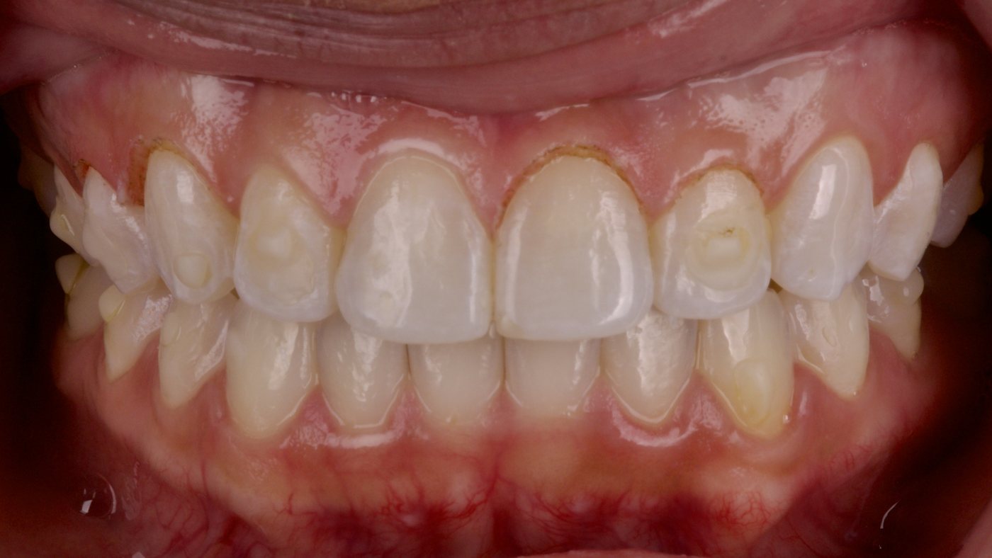 After: gum tissue reshaped with a laser