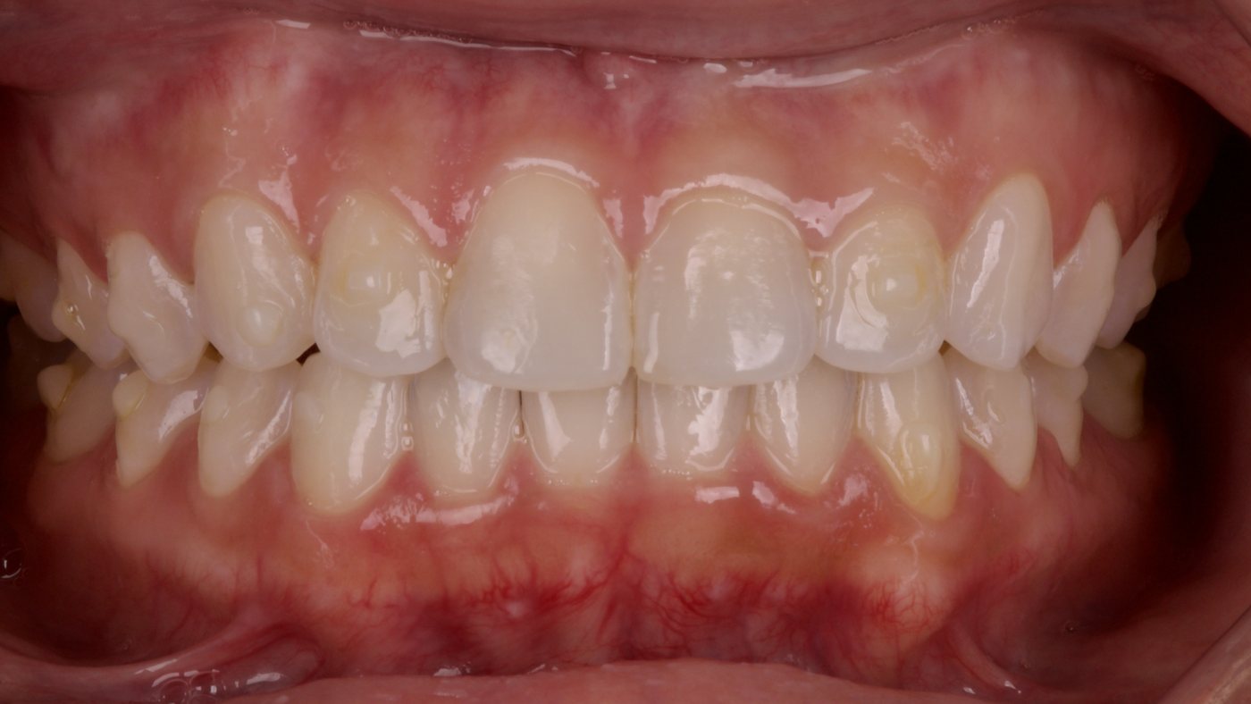 Before: uneven gum tissue