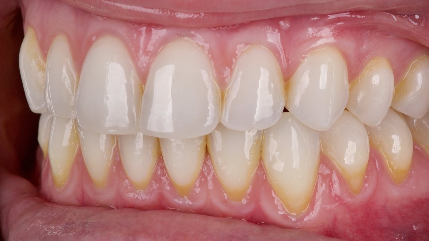 After: a gum graft covering the root