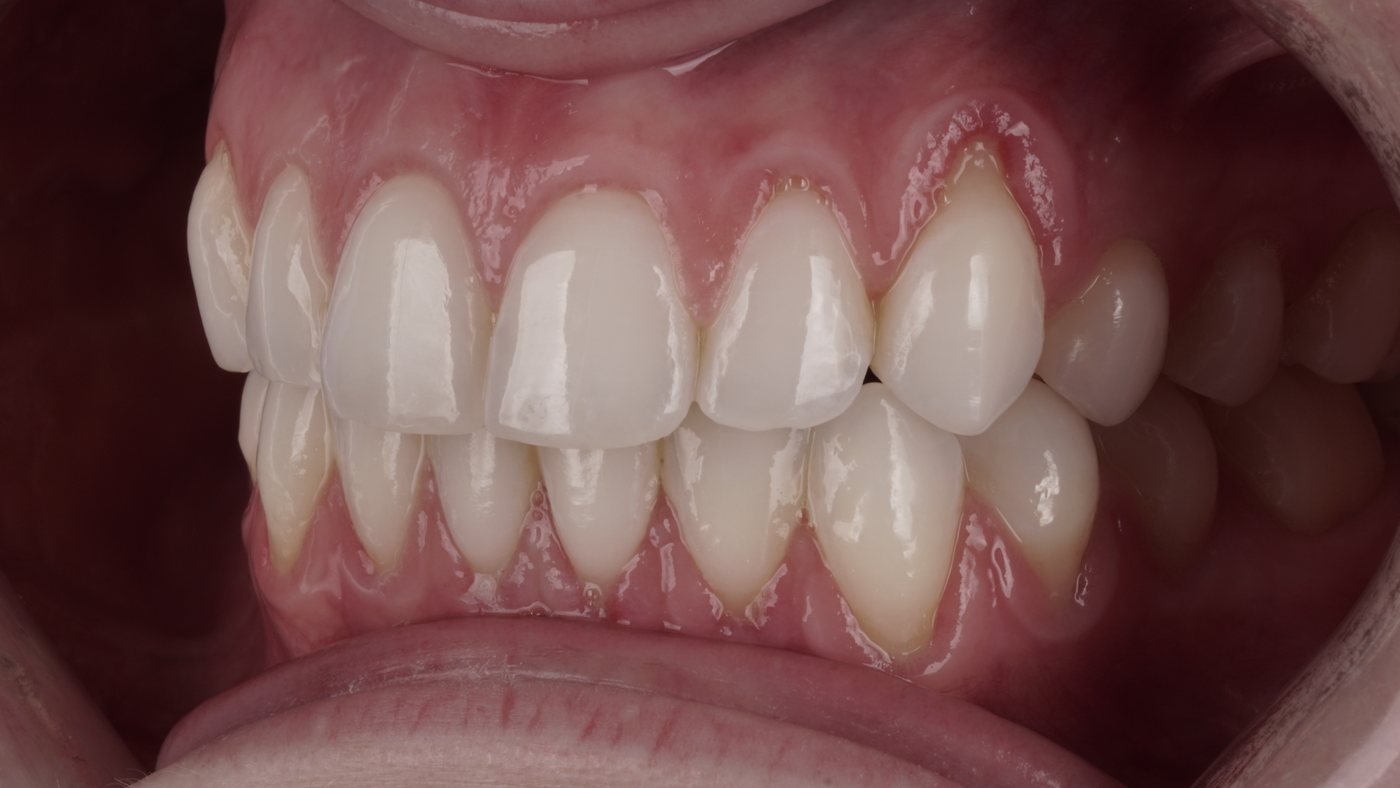 Before: gum recession exposing the tooth root