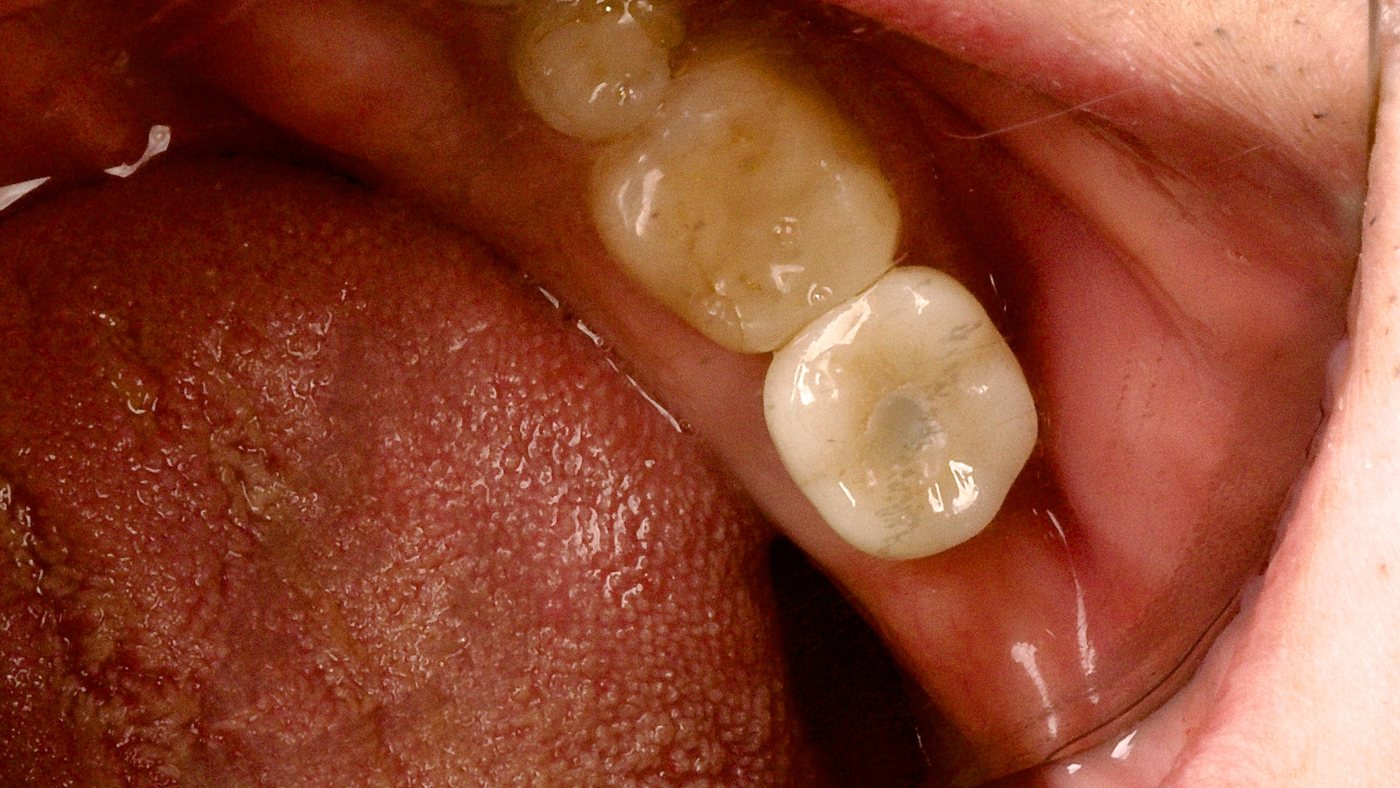 After: a dental implant with a custom crown