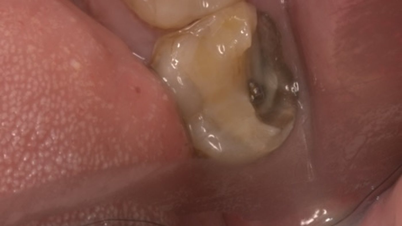 Before: a broken-down back molar