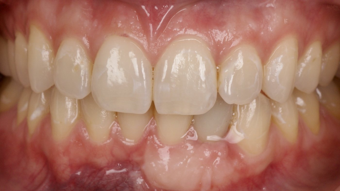 An implant restoration matched to the neighboring teeth, on a patient of the practice