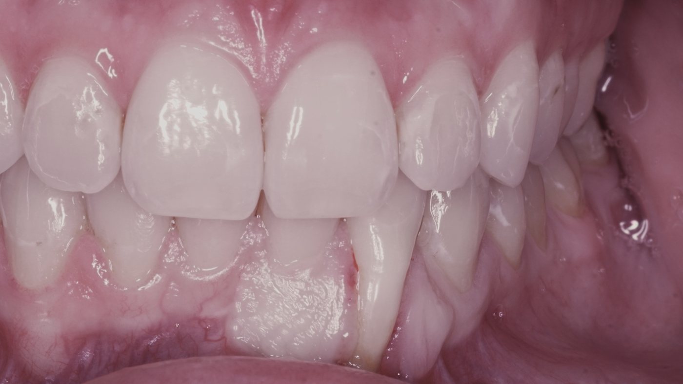 Before: a missing lower front tooth