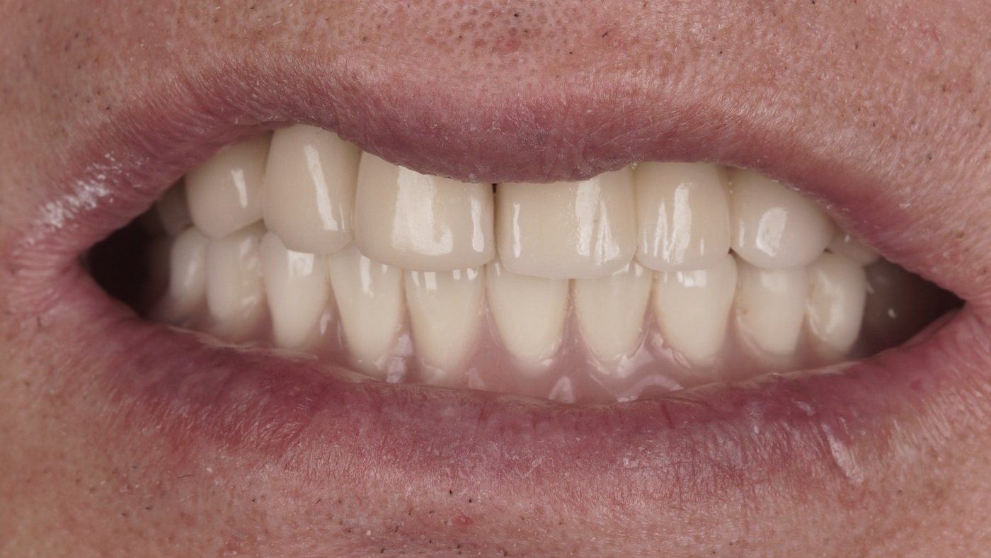 The finished denture fitted onto the implants