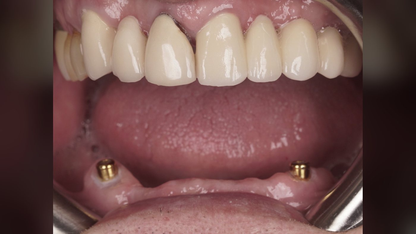 Two dental implants placed in the lower jaw