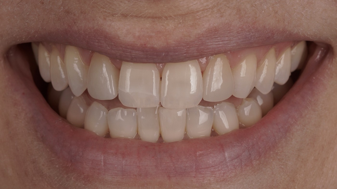 After: porcelain veneers