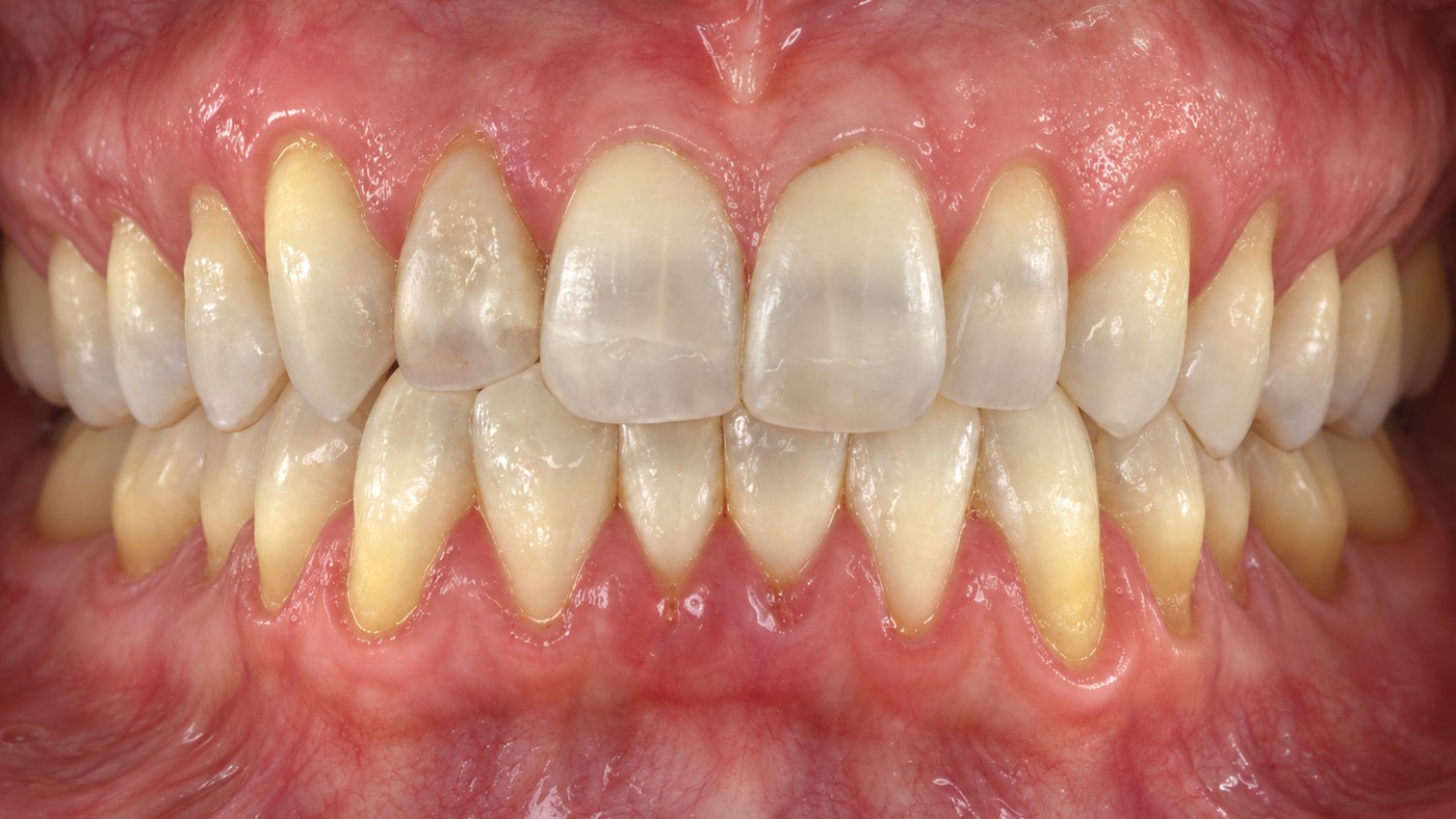 Before: dull, uneven teeth with exposed roots
