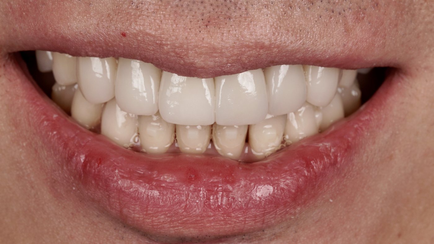 Porcelain veneers on a patient of the practice, after treatment