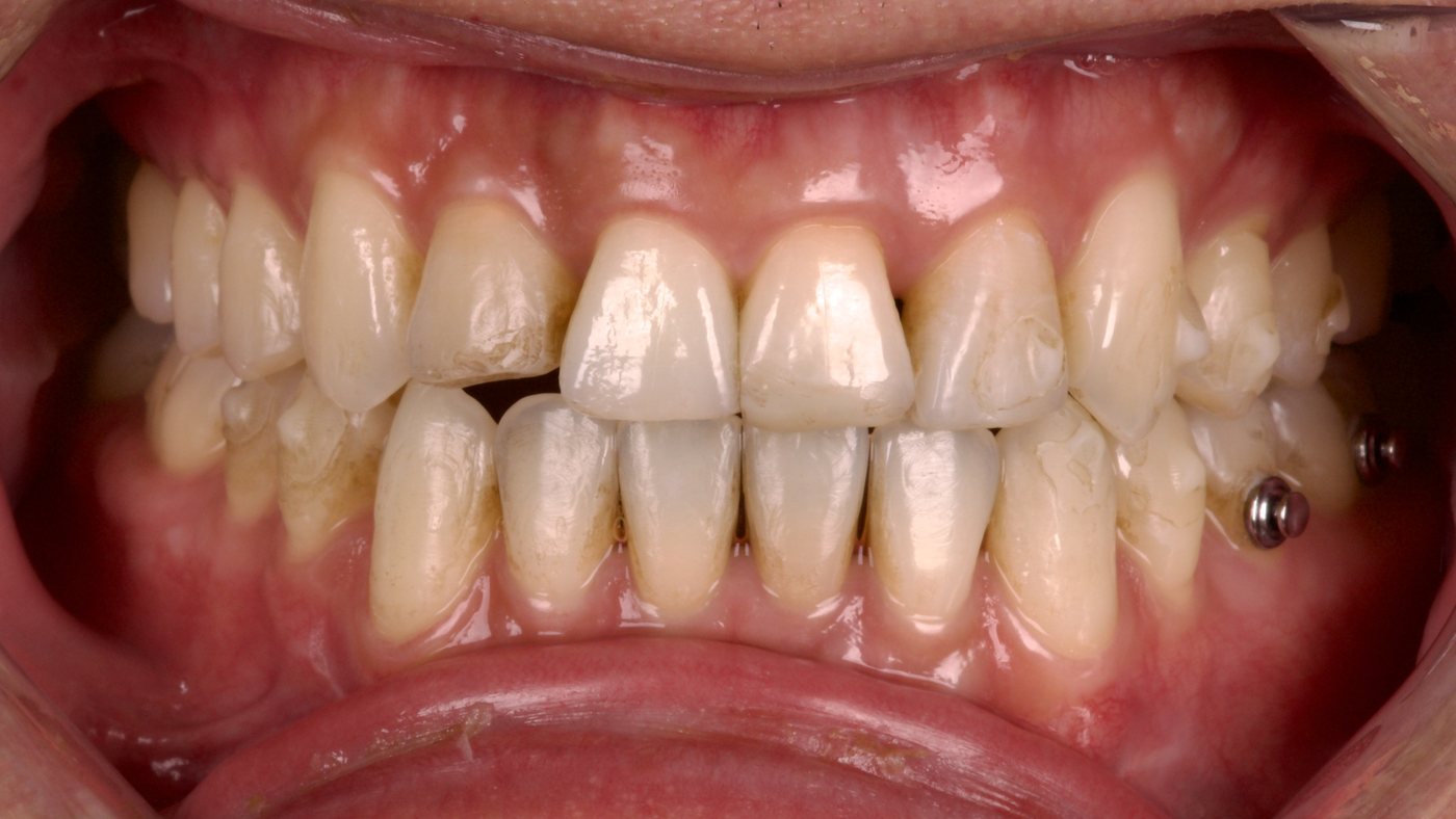 Before: worn, uneven front teeth