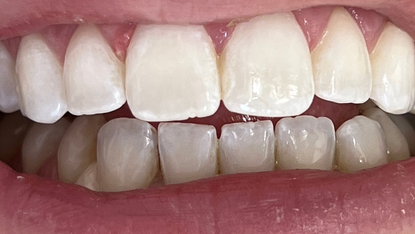 After: Teeth before and after professional whitening