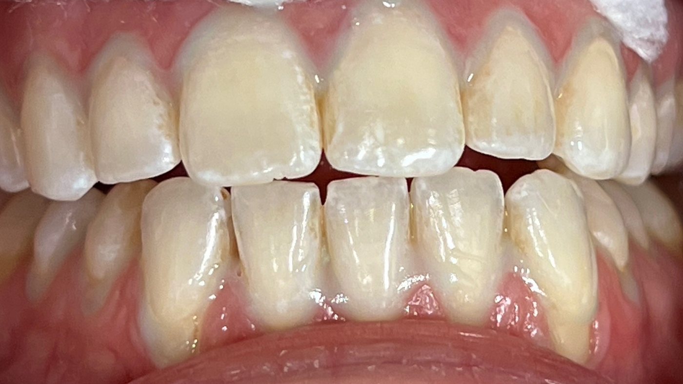 Before: Teeth before and after professional whitening