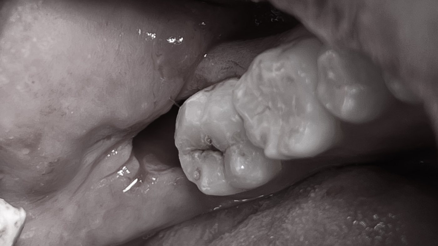 After: the extraction site, with no cutting of gum or bone