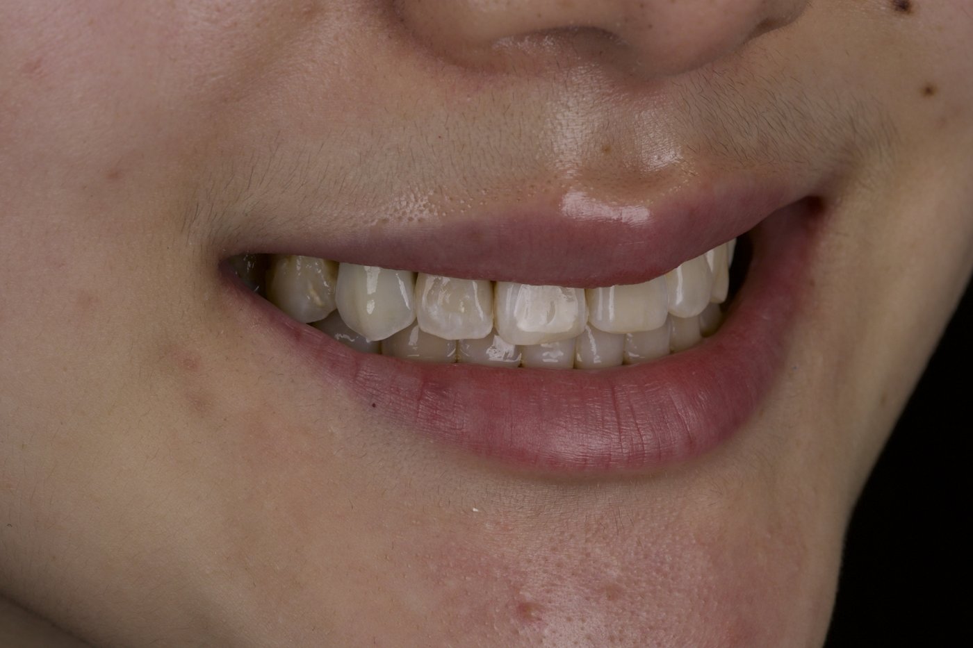After treatment