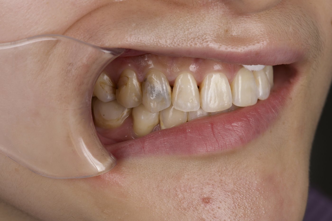 Before treatment