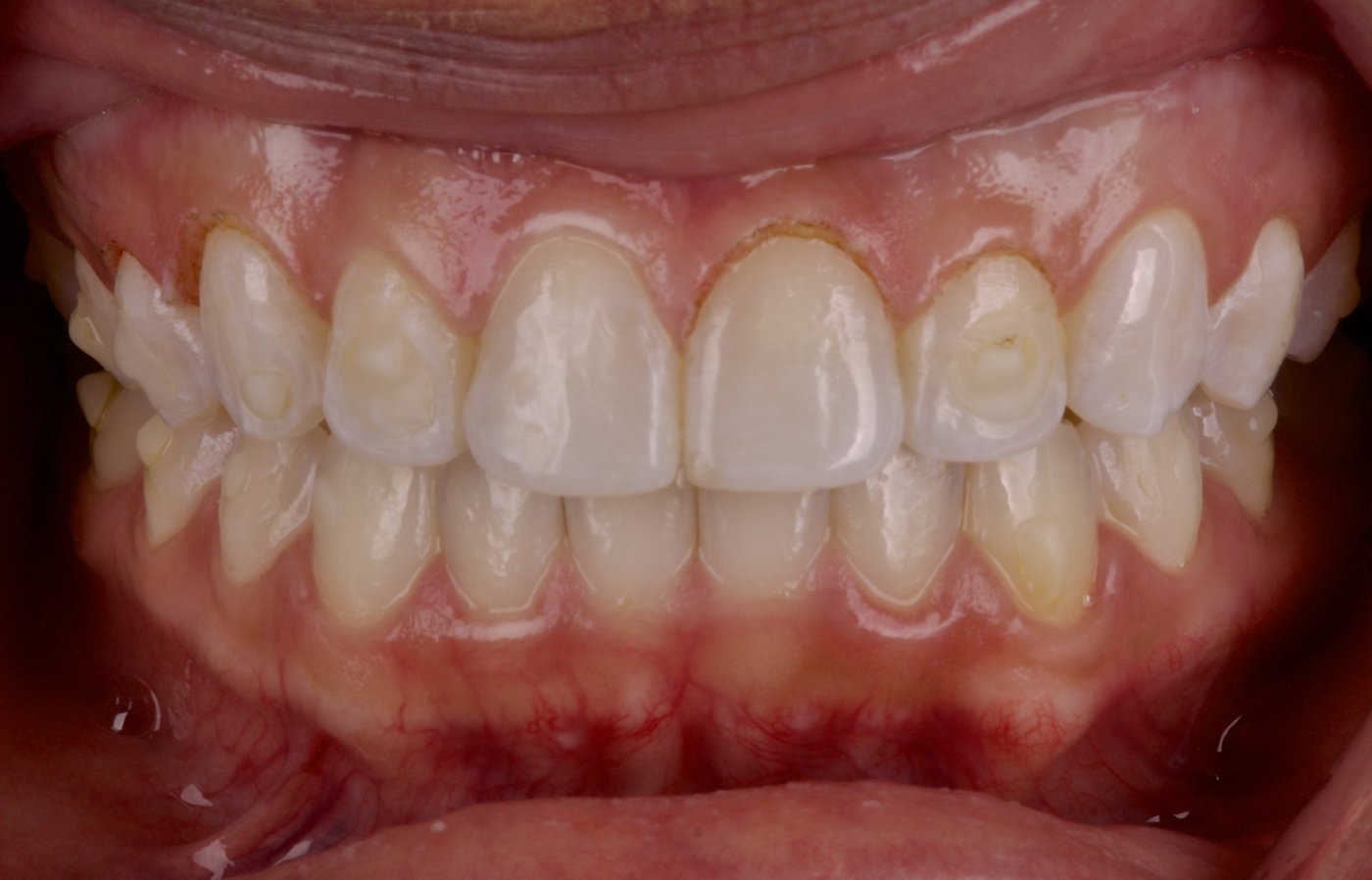After treatment