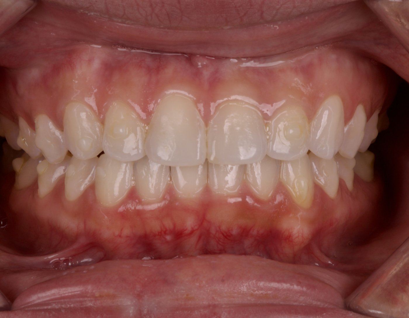 Before treatment