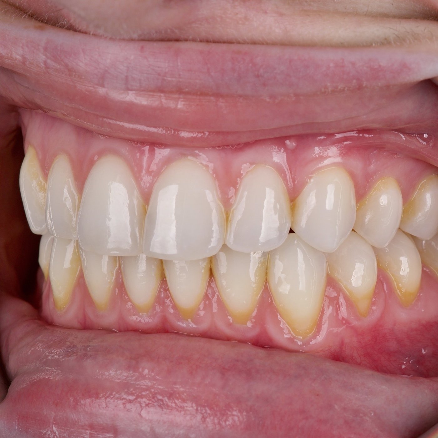 After treatment