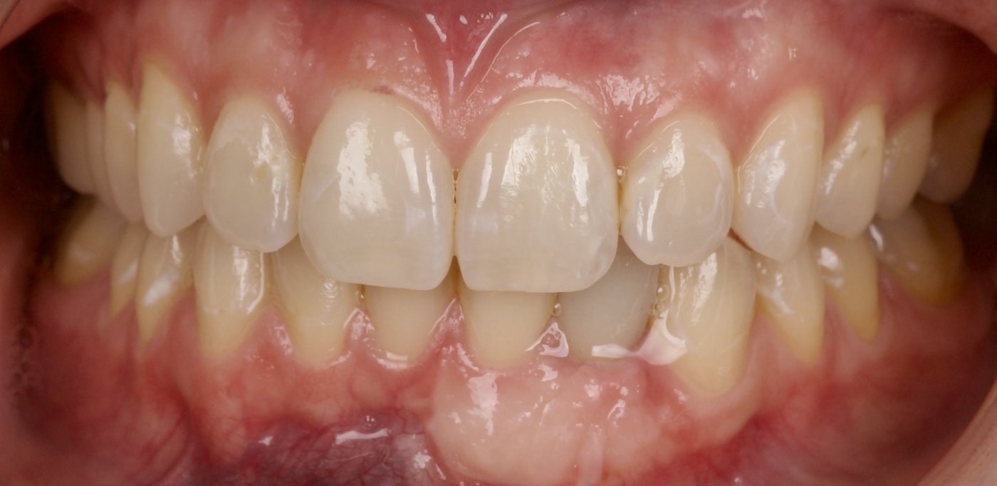 After treatment