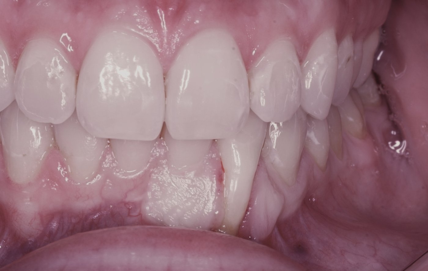 Before treatment