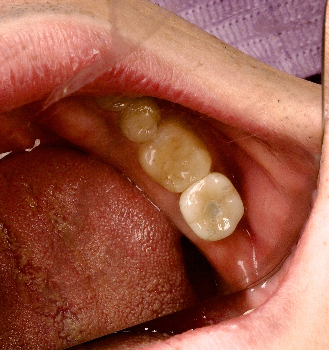 After treatment