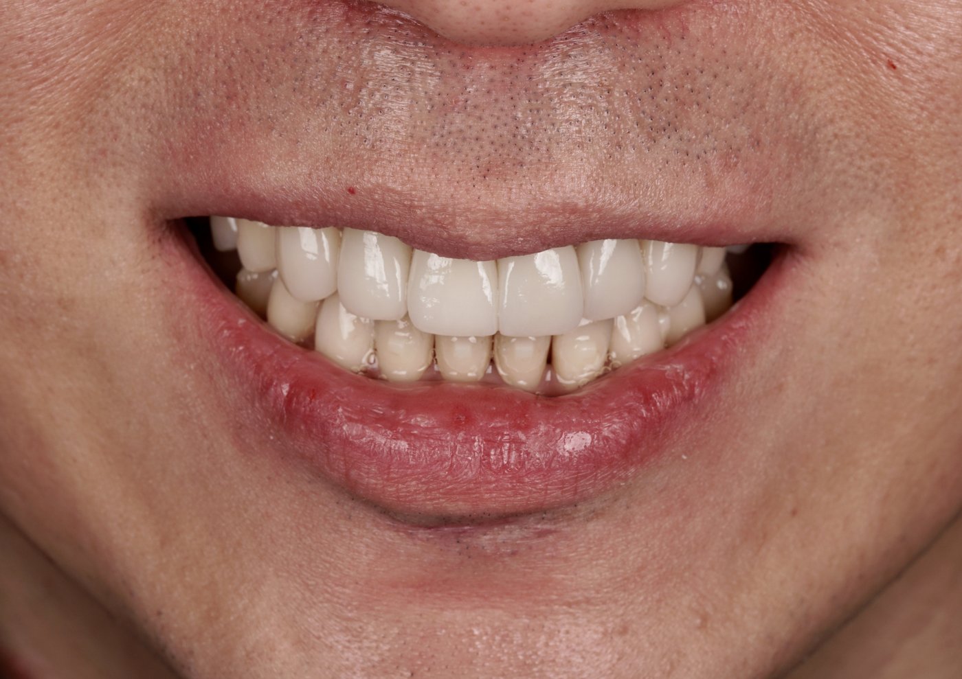 After treatment