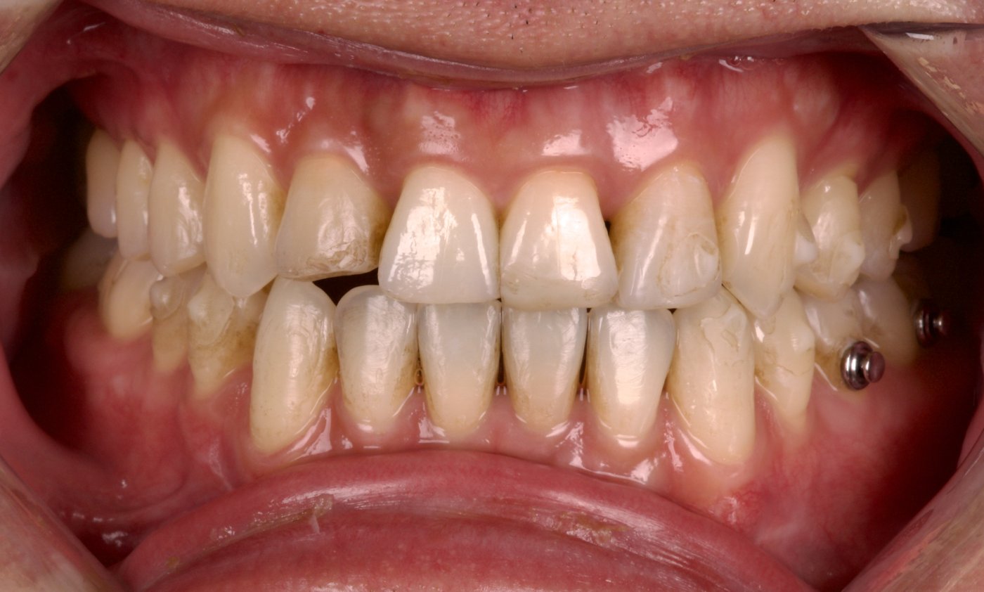 Before treatment